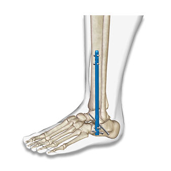 Ankle Fusion Pin
