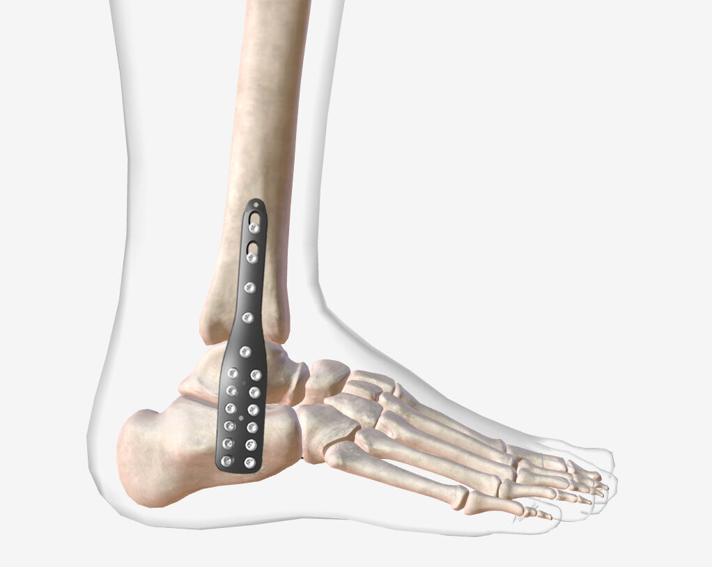 Advanced Locking Technology for Enhanced Stability