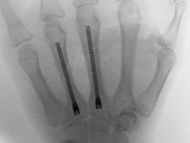 Antegrade Intramedullary Screw Fixation for Metacarpal Fractures: A Novel Technique