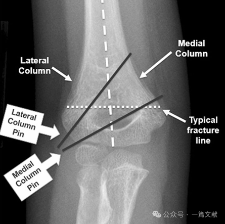 Treatment of Pediatric Supracondylar Humerus Fractures