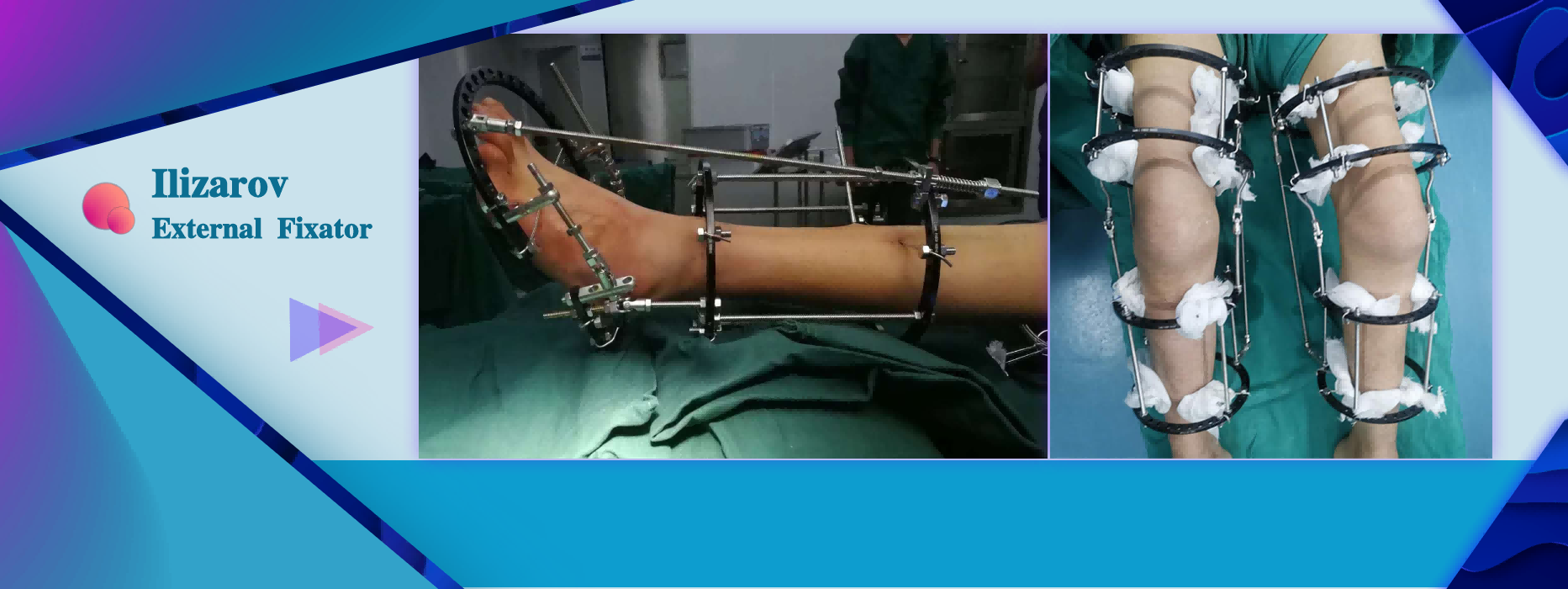 Orthopedic Surgery for Limbs