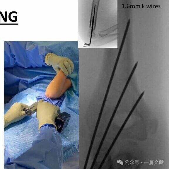 Treatment of Pediatric Supracondylar Humerus Fractures