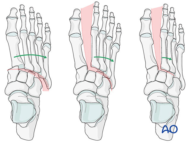 Kirurška ilustracija poškodbe Lisfranc, standard AO!
