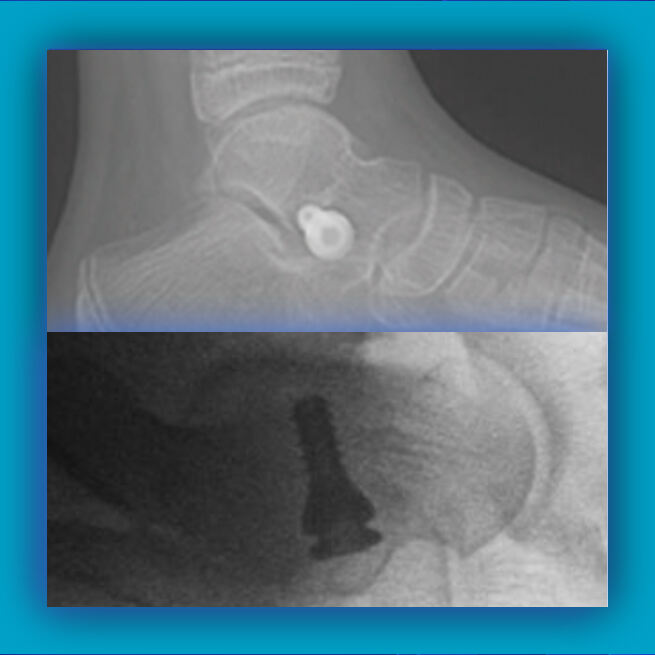 Subtalar Joint Fixation Surgery