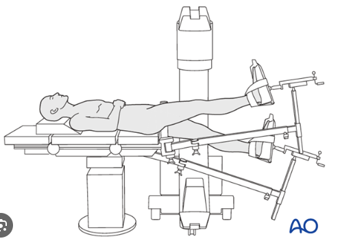 Guia Prático para a Cirurgia de Fixação Intramedular da Fêmur Proximal (PFN)