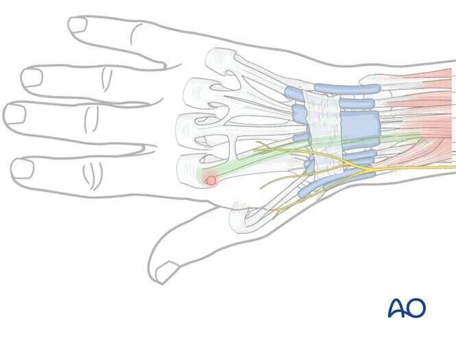 Transarticular External Fixation for Distal Radius Fractures