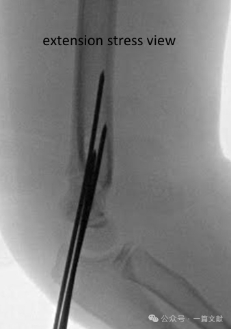 Treatment of Pediatric Supracondylar Humerus Fractures