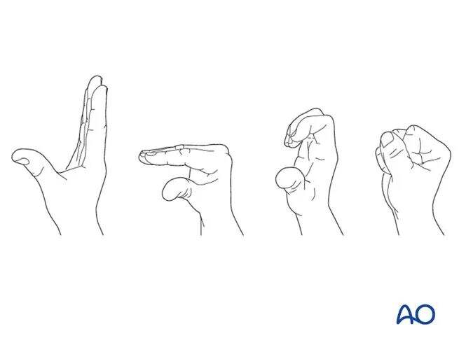 Transarticular External Fixation for Distal Radius Fractures