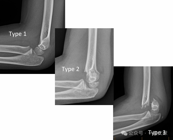Treatment of Pediatric Supracondylar Humerus Fractures