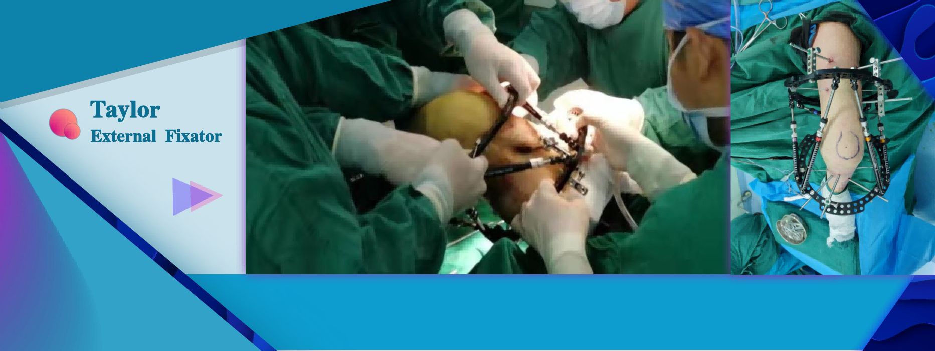 Bone Deformity Correction Surgery