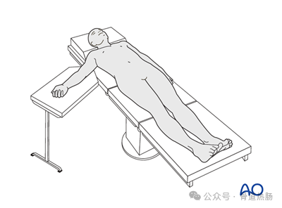 External fixation（Simple humeral shaft fracture, spiral fracture.）
