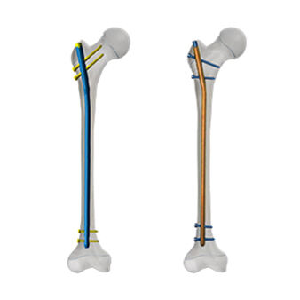 Femoral Bone Marrow Nail in Children