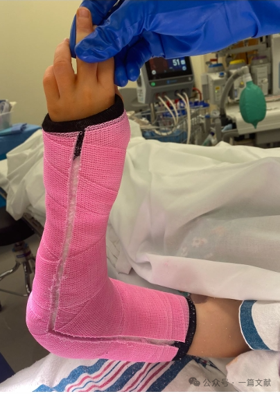 Treatment of Pediatric Supracondylar Humerus Fractures