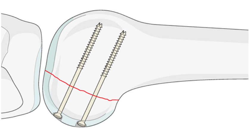 Open Reduction and Internal Fixation with Plate for Hoffa Fracture
