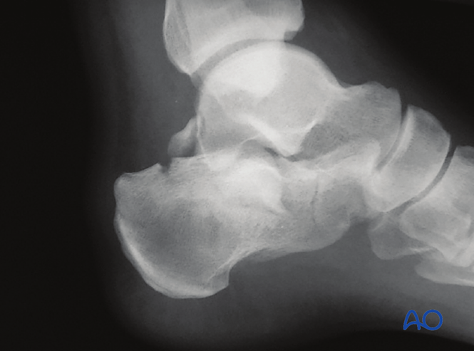 The Extended Lateral Approach to the Calcaneus – The Large L-Shaped Incision