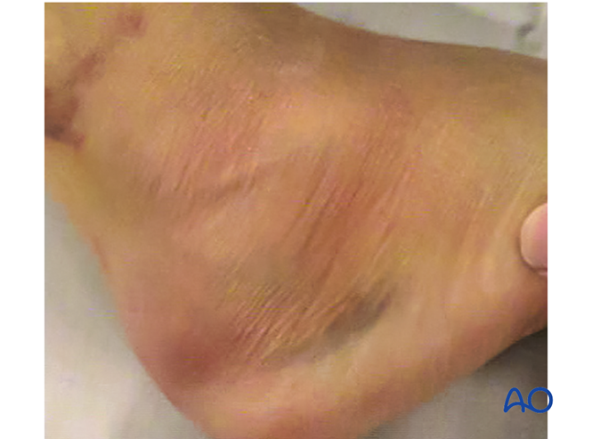 The Extended Lateral Approach to the Calcaneus – The Large L-Shaped Incision