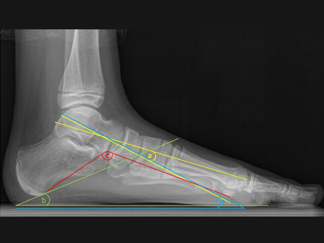 Clinical and radiographic efficacy of subtalar screw arthroereisis in the treatment of pediatric flexible flatfoot