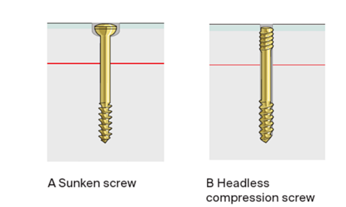 Open Reduction and Internal Fixation with Plate for Hoffa Fracture