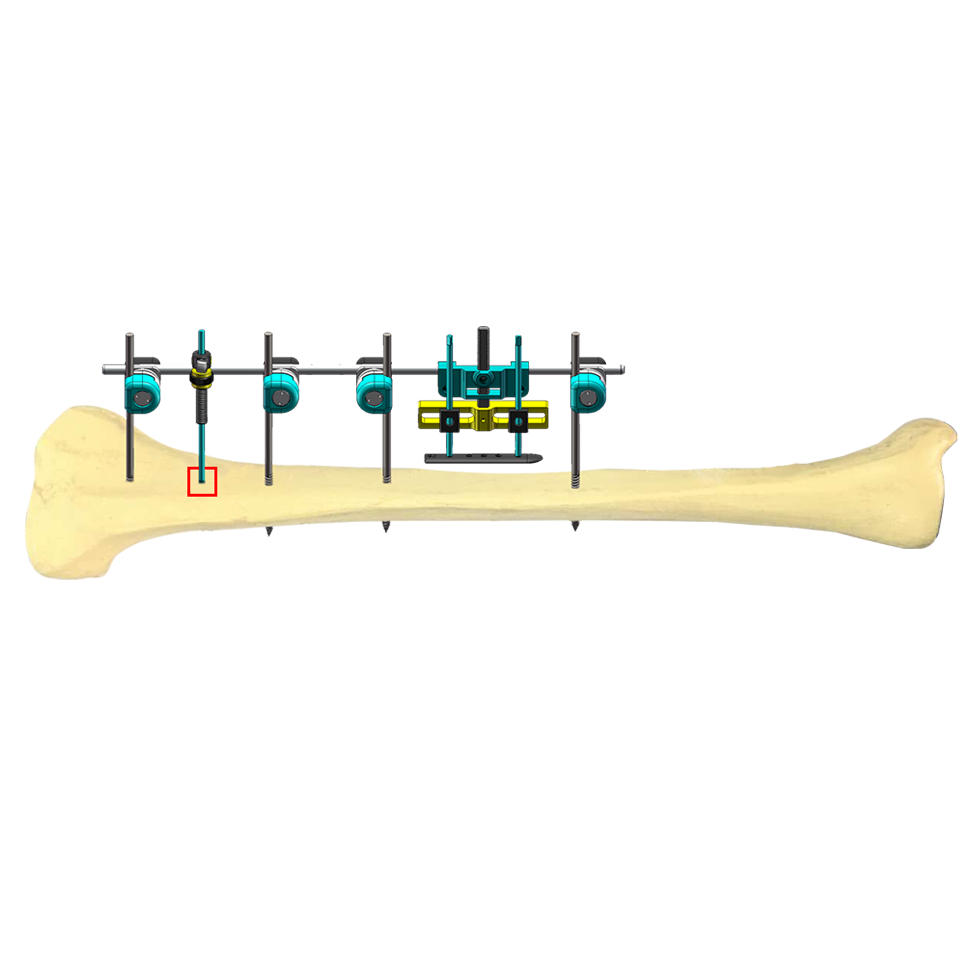 Dynamic Adjustability and Postoperative Control