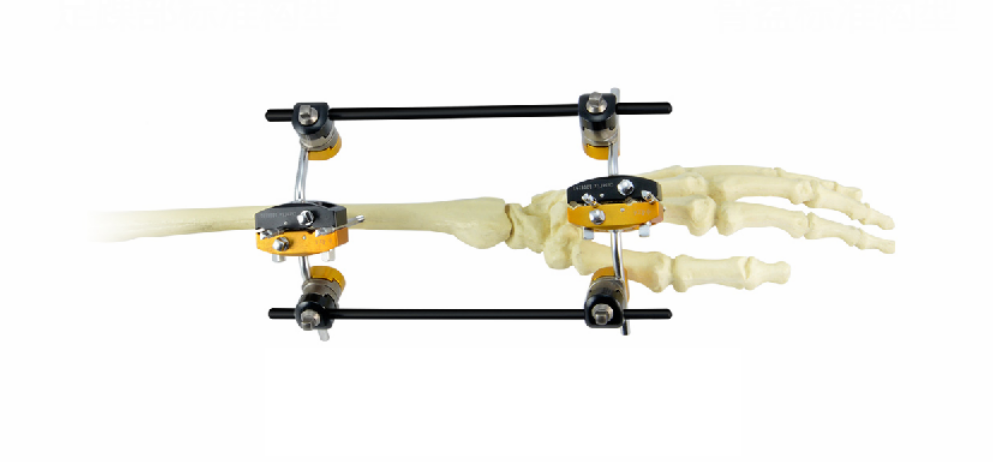 Advanced Adjustability for Optimal Bone Alignment
