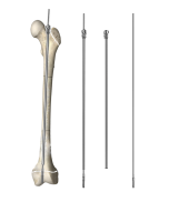 Extended Intramedullary Needle: A Dynamic Fixation Technique Adapted to Bone Growth in Children