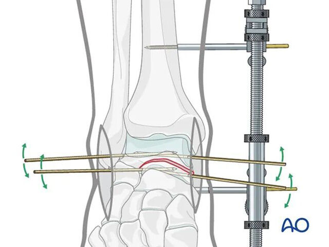 AO standardna kirurgija: vijakna fiksacija pri premaknjenih zlomih vratu talusa