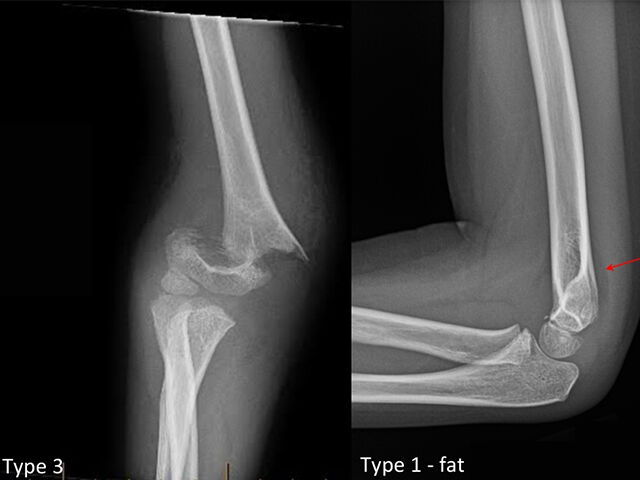 Treatment of Pediatric Supracondylar Humerus Fractures