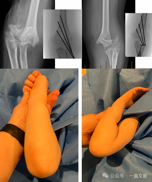 Treatment of Pediatric Supracondylar Humerus Fractures
