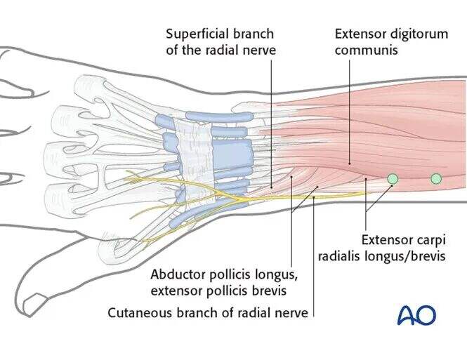 Transarticular External Fixation for Distal Radius Fractures