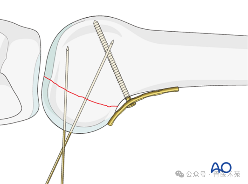 Open Reduction and Internal Fixation with Plate for Hoffa Fracture
