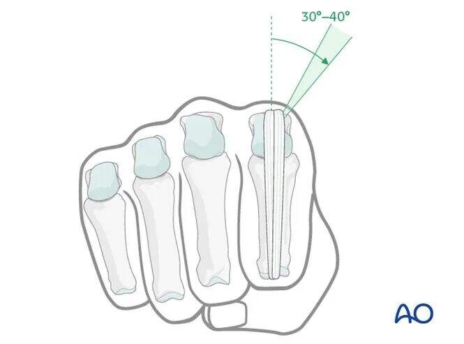 Transarticular External Fixation for Distal Radius Fractures