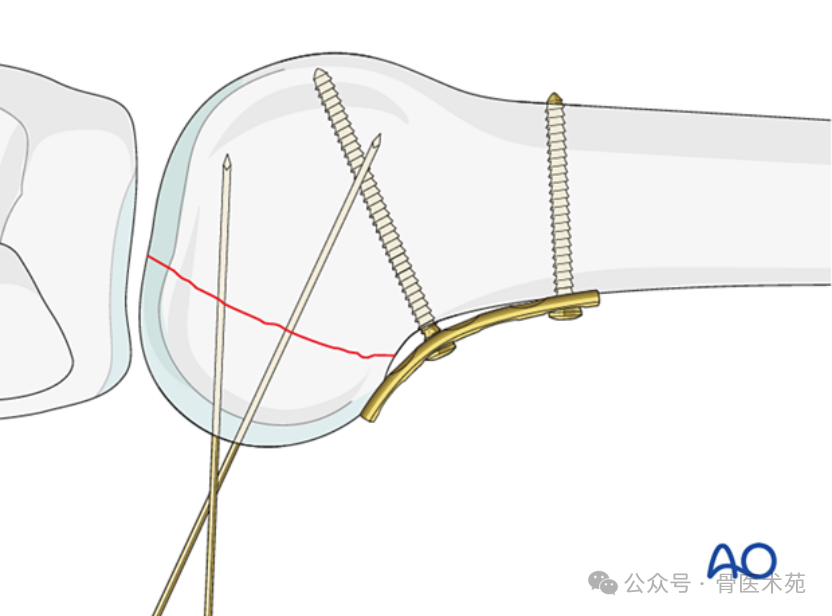 Open Reduction and Internal Fixation with Plate for Hoffa Fracture