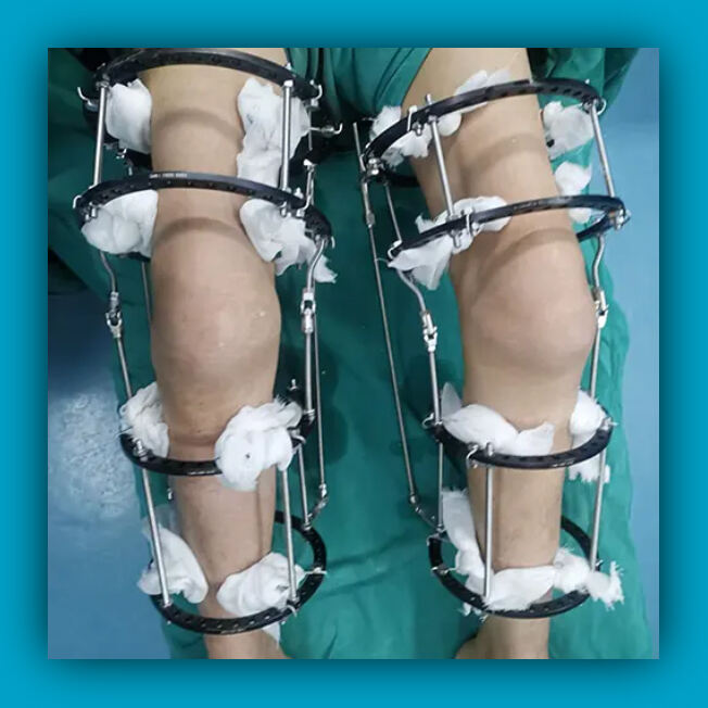 Orthopedic Surgery For Limbs