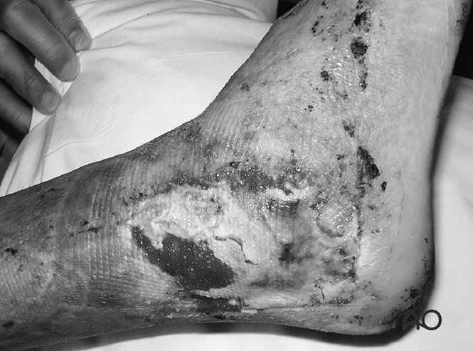 The Extended Lateral Approach to the Calcaneus – The Large L-Shaped Incision