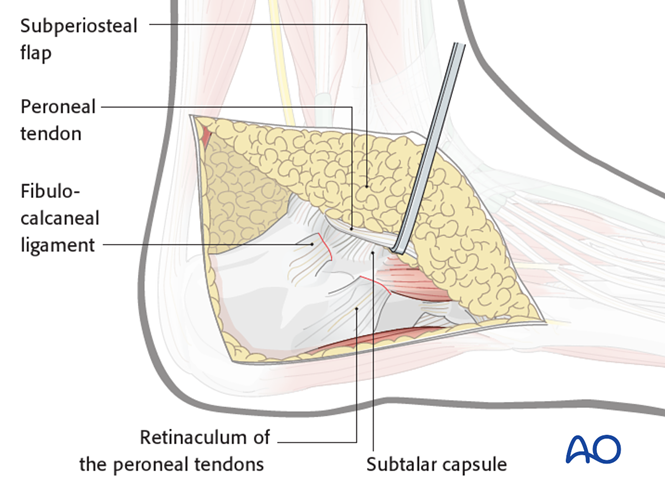 The Extended Lateral Approach to the Calcaneus – The Large L-Shaped Incision