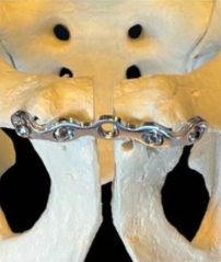 Advanced Locking Technology for Superior Fixation