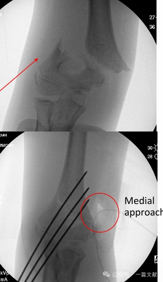 Treatment of Pediatric Supracondylar Humerus Fractures