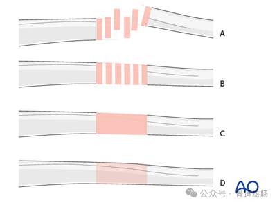 External fixation（Simple humeral shaft fracture, spiral fracture.）