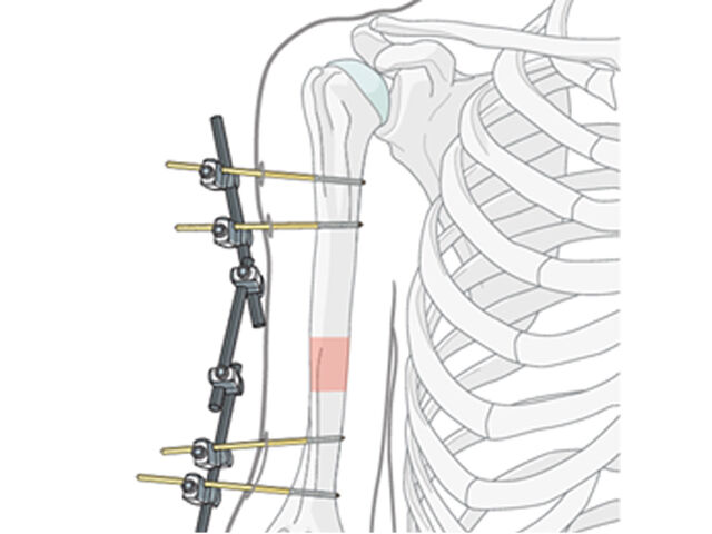 External fixation（Simple humeral shaft fracture, spiral fracture.）