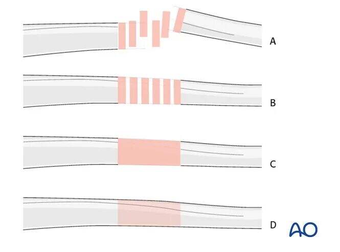 transarticular external fixation for distal radius fractures-1