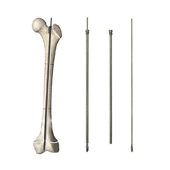Telescopic Intramedullary Nail