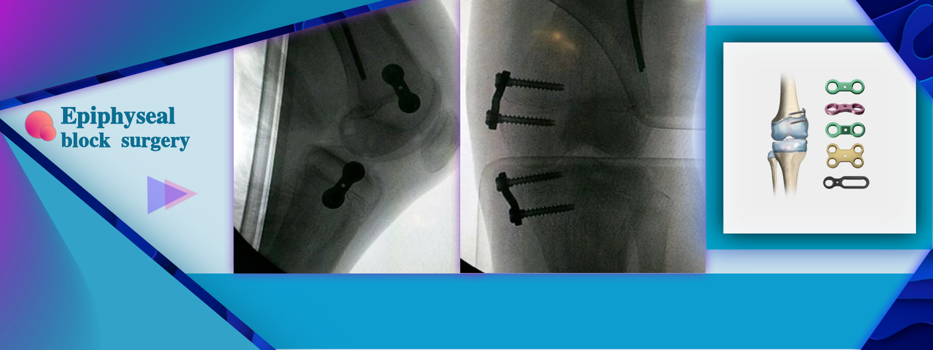 Half Epiphyseal Block surgery For Children's Limbs