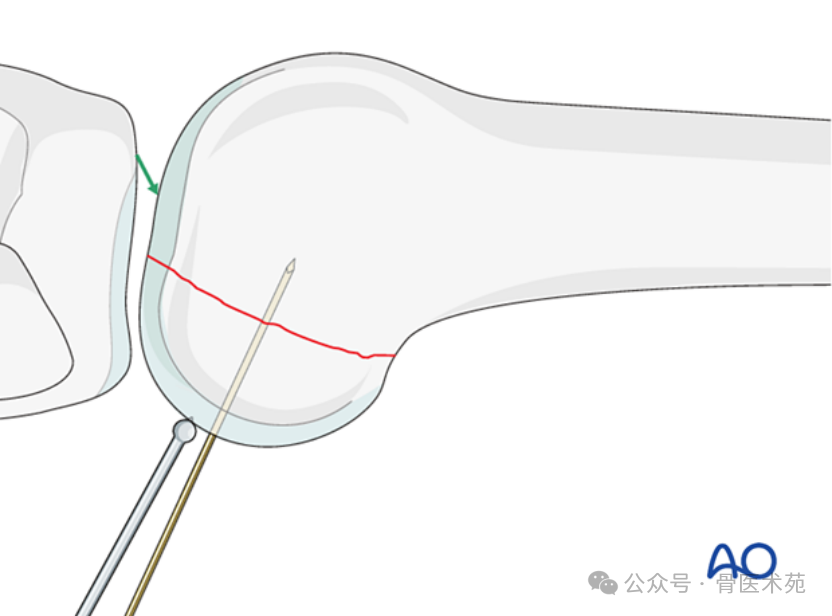 Open Reduction and Internal Fixation with Plate for Hoffa Fracture