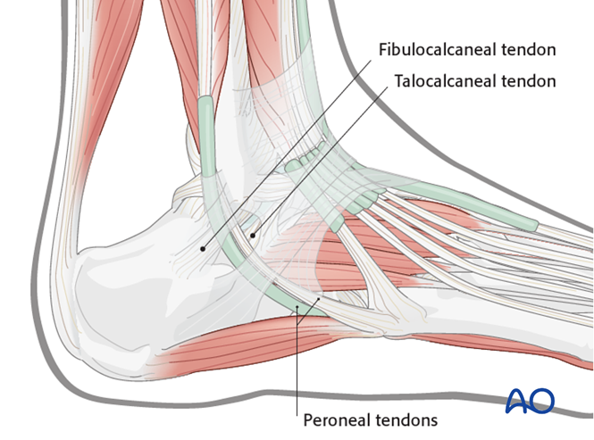 The Extended Lateral Approach to the Calcaneus – The Large L-Shaped Incision