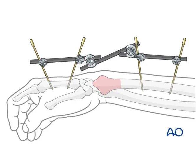 Transarticular External Fixation for Distal Radius Fractures