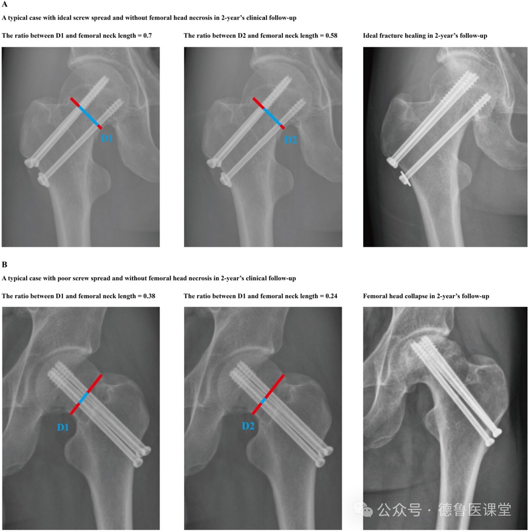 A maior distância entre os parafusos pode reduzir o risco de necrose do colo femoral a curto prazo, otimizando a estabilidade da fixação em pacientes com fratura do colo femoral submetidos à fixação com parafusos canulados em triângulo