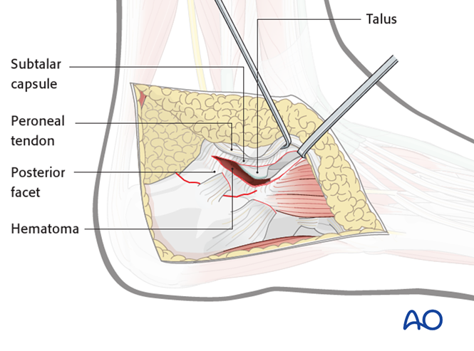 The Extended Lateral Approach to the Calcaneus – The Large L-Shaped Incision
