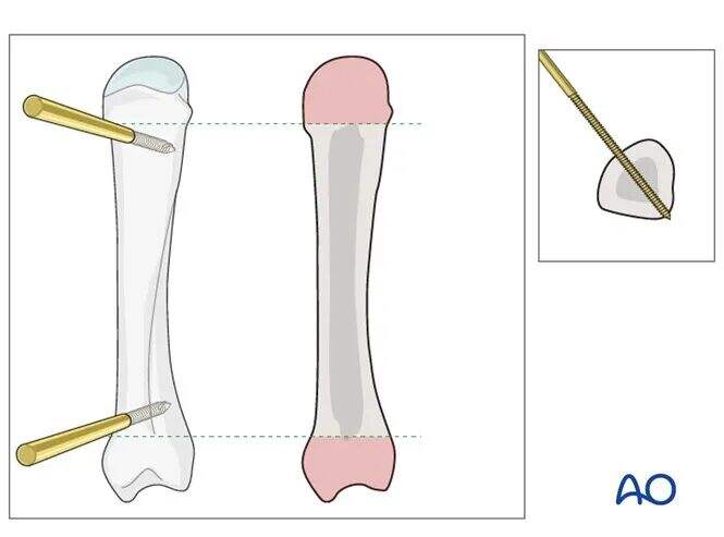 Transarticular External Fixation for Distal Radius Fractures