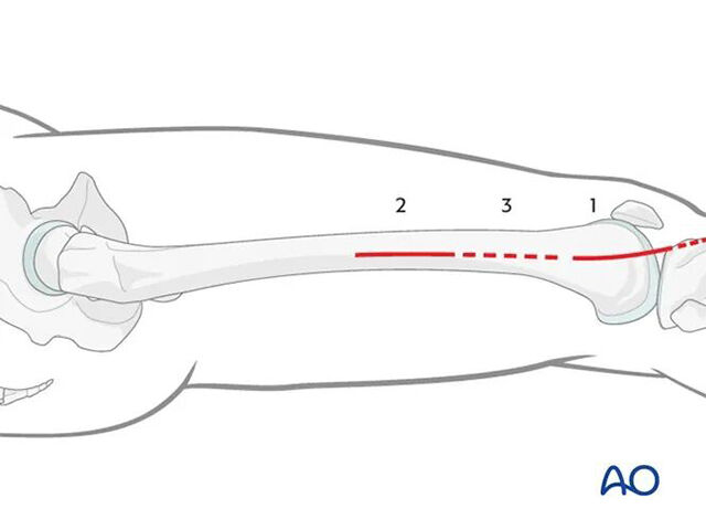 Minimally invasiv lateral/antrolateral MIPO-approach till distala femur