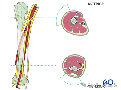 External fixation（Simple humeral shaft fracture, spiral fracture.）